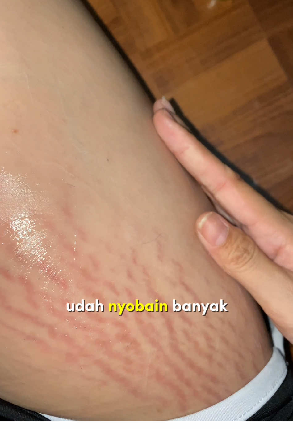 Jauh bgt ya perbedaannya? #stretchmarks #rintikstretchmarkoil 