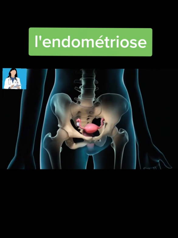 #endometriosis #endometriose #endometriosisawareness #icionapprendlamedecine 