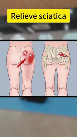 Quick Sciatica Relief Stretch You’ll Wish You Knew Sooner.#SciaticaRelief#PainFreeLiving#StretchWithEase