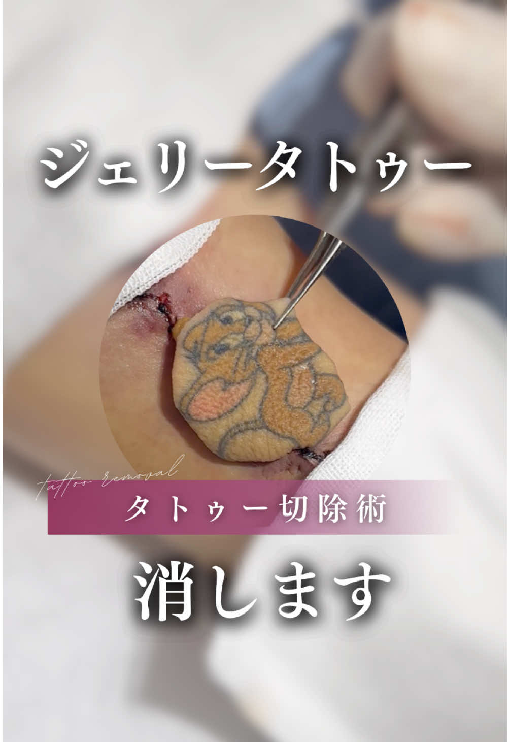 ジェリータトゥー消しちゃいます🐭🤍 〈施術内容〉 タトゥー切除術 【価格】※税抜モニター価格 頭頚部、前腕、手背、下腿、足背、指以外/1cm 22,000円 頭頚部、前腕、手背、下腿、足背/1cm      27,500円 手指、足指 / 1cm    33,000円 【副作用・リスク】 かさぶた、色素沈着、赤み、稀に水疱形成 ✨全国24院展開✨ 各院の詳細はプロフィールのInstagramへ #タトゥー #タトゥー除去 #タトゥー切除 #美容医療 #美容整形