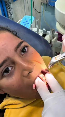 خلع ضرس لبني #دكتور_عبدالله_سلطان_الهنداوي_طبيب_اسنان #طبيب_اسنان_دكتور_عبدالله_سلطان 