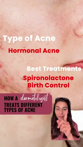 Understanding different types of acne and how to treat them! . In this video, I break down various acne types and share effective treatment strategies for each. Say goodbye to breakouts and hello to clear, healthy skin! . . . . . . . . #AcneTreatment #ClearSkinJourney #SkinCareTips #dermatologist #doctor #skincare #cosmeticdermatology #acne #skin #SelfCare #dermatology #manhattanbeachdermatology #dermatologist #dermatology #drninadesai #dermtips #dermatologyrocks