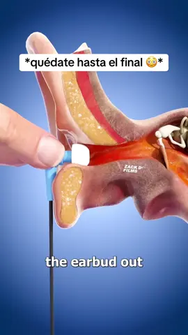 No puedo creer que tenía esto en el hueco!! 😱 #earwax #earwaxremoval #qtips #pimplepopper #satisfying #viral #TikTokShop #flashsale #fyp 