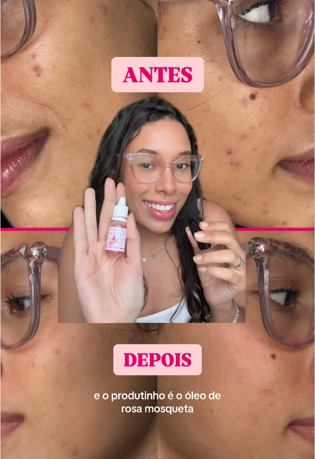 como acabar com as mancinhas de acne! 💖 #skincare #manchas #rosamosquesta #dicasdeskincare #acne 