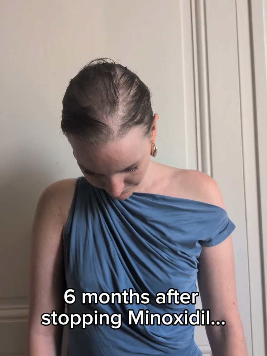 6 months after stopping Minoxidil #alopecia #hairloss #hairlossjourney #hairlosstiktok #hairlosstreatment #androgenicalopecia #alopeciaawareness #minoxidilresult #minoxidil #minoxidil5 #minoxidilbeforeandafter #stopminoxidil #quitonminoxidil #afterminoxidil #rogaine #hairlossremedy #hairgrowthjourney #CapCut 