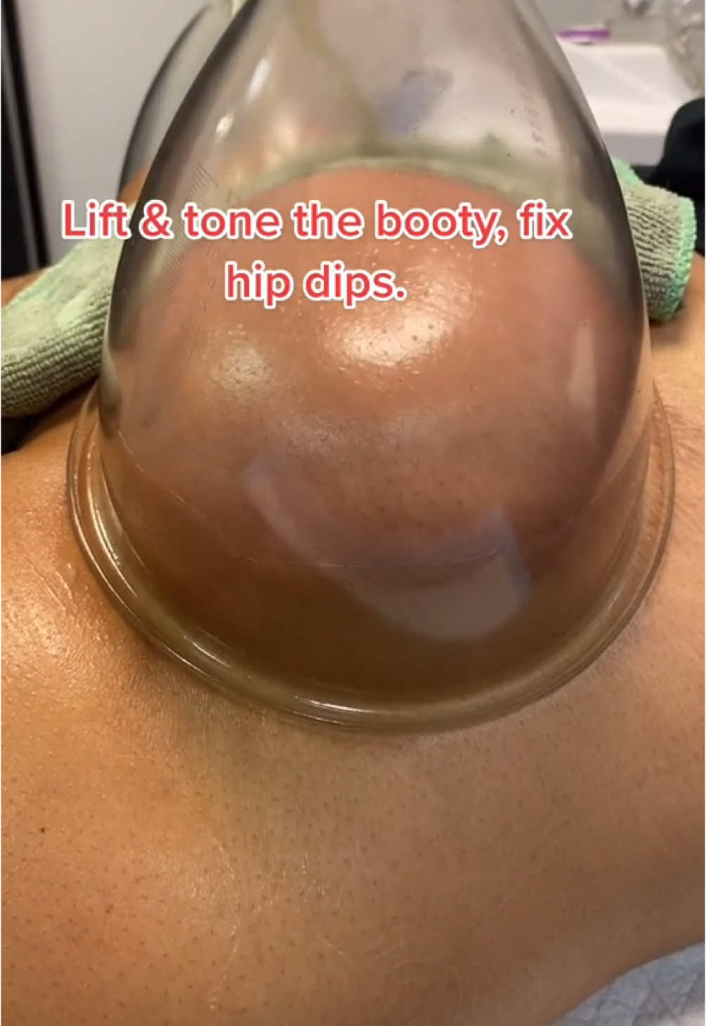 Butt Enhancement, reduce thigh  fat, cellulite & hip dips #buttenhance #bodycontouring #bodysculpting #buttlif #bbl #bblcheck #foryoupage