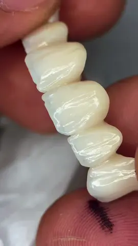 Full Zircone 🦷➡️By👉 Zircontech-Lab🇹🇳🇹🇳#exocadexpert #prothesedentaire🦷🦷 #dentalcare🦷🦷🦷 #dentalimplants #مخبراسنان 