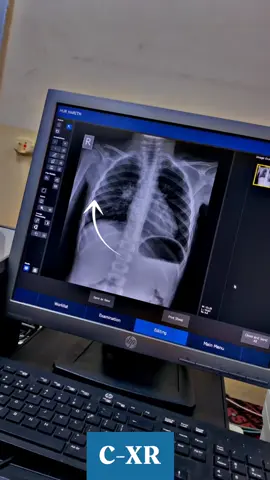 اشعة الصدر (Chest x-ray )  #أشعة_سينية #تقني #اشعة_تشخيصية 