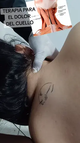 #neuropatia #nerviociatico #electroacupuntura #terapianeural #homeopatia #dolorescapular #masajeterapeutico #dolordecuello