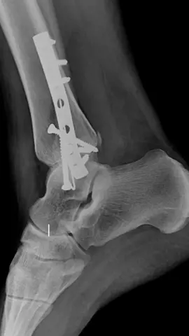 Yo la tomo diariamente y me ha ayudado mucho con la recuperación #fractura #tibiayperone #recuperacion #grenetina 👏🏻