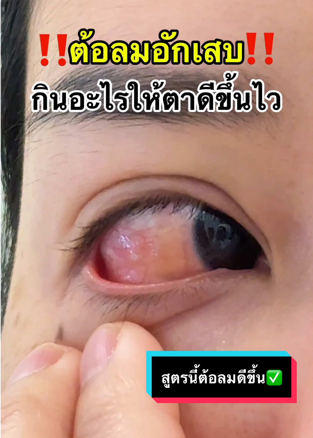 ต้อลมอักเสบ แนะนำทานสูตรนี้🙋🏻‍♀️ #น้ํามลมินิ #อาโมนิ #อาโมนิลูทีน #อาโมนิซิงค์ #อาโมนิลูทีนและซิงค์ #วิตามินบํารุงสายตา #วิตามินบํารุงดวงตา 
