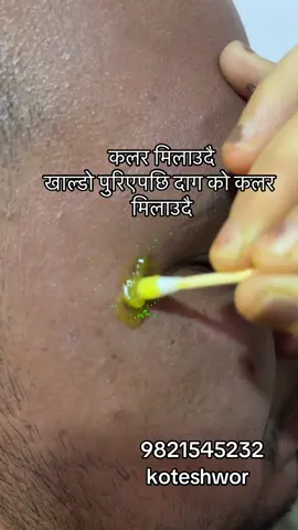 #plasma #facialtreatment #pigmentation #scar #wrinkles #skincare #pigmentation #wrinkles #acnetreatment #skincareroutine #fyppppppppppppppppppppppp #goviral 