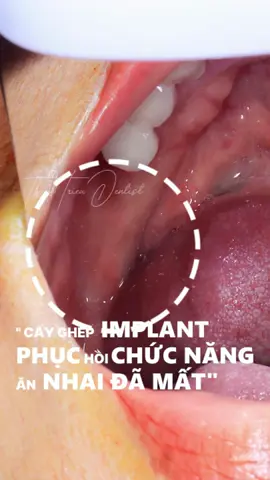 🔩🦷 CẤY GHÉP IMPLANT – PHỤC HÌNH RĂNG SỨ TẠI NHA KHOA THANH TRIỀU ✨ Giải pháp phục hồi răng mất an toàn – bền vững – thẩm mỹ vượt trội! Mất răng không chỉ ảnh hưởng đến ăn nhai, mà còn làm tiêu xương hàm, lệch khớp cắn và khiến gương mặt già đi nhanh chóng. Nhưng đừng lo – tại Nha Khoa Thanh Triều, chúng tôi mang đến giải pháp cấy ghép implant kết hợp phục hình răng sứ, giúp bạn lấy lại hàm răng chắc khỏe và nụ cười rạng rỡ như xưa! 💎 Vì sao nên chọn Implant + Răng sứ tại Nha Khoa Thanh Triều? ✅ Phục hồi khả năng ăn nhai chắc khỏe lên đến 95% – ăn được cả đồ cứng, dai, không lo ê buốt. ✅ Răng sứ có màu sắc và hình dáng tự nhiên như răng thật – đảm bảo thẩm mỹ tối đa. ✅ Không cần mài răng thật như làm cầu răng truyền thống – bảo tồn răng tự nhiên. ✅ Ngăn ngừa tiêu xương hàm, giữ nét trẻ trung cho gương mặt. ✅ Thực hiện bởi bác sĩ Bùi Thanh Triều – Chuyên khoa 1, nhiều năm kinh nghiệm cấy ghép implant và phục hình thẩm mỹ. 💬 Tại sao khách hàng tin chọn Nha Khoa Thanh Triều? ✔️ Quy trình vô trùng – chuẩn y khoa ✔️ Trang thiết bị hiện đại – máy chụp CT Cone Beam 3D hỗ trợ chẩn đoán chính xác ✔️ Chăm sóc tận tâm – tư vấn kỹ lưỡng từng trường hợp 📍 Đừng để việc mất răng ảnh hưởng đến chất lượng cuộc sống! 💬 Inbox ngay hoặc gọi trực tiếp để được bác sĩ tư vấn miễn phí và lên kế hoạch điều trị phù hợp.#xh #fyp #lamdep #implant #rangsuthammy #dansuveneer #niengrang #taytrangrang #chamsocrangmieng #nhakhoathanhtrieu #nhakhoauytin #xuhuong 