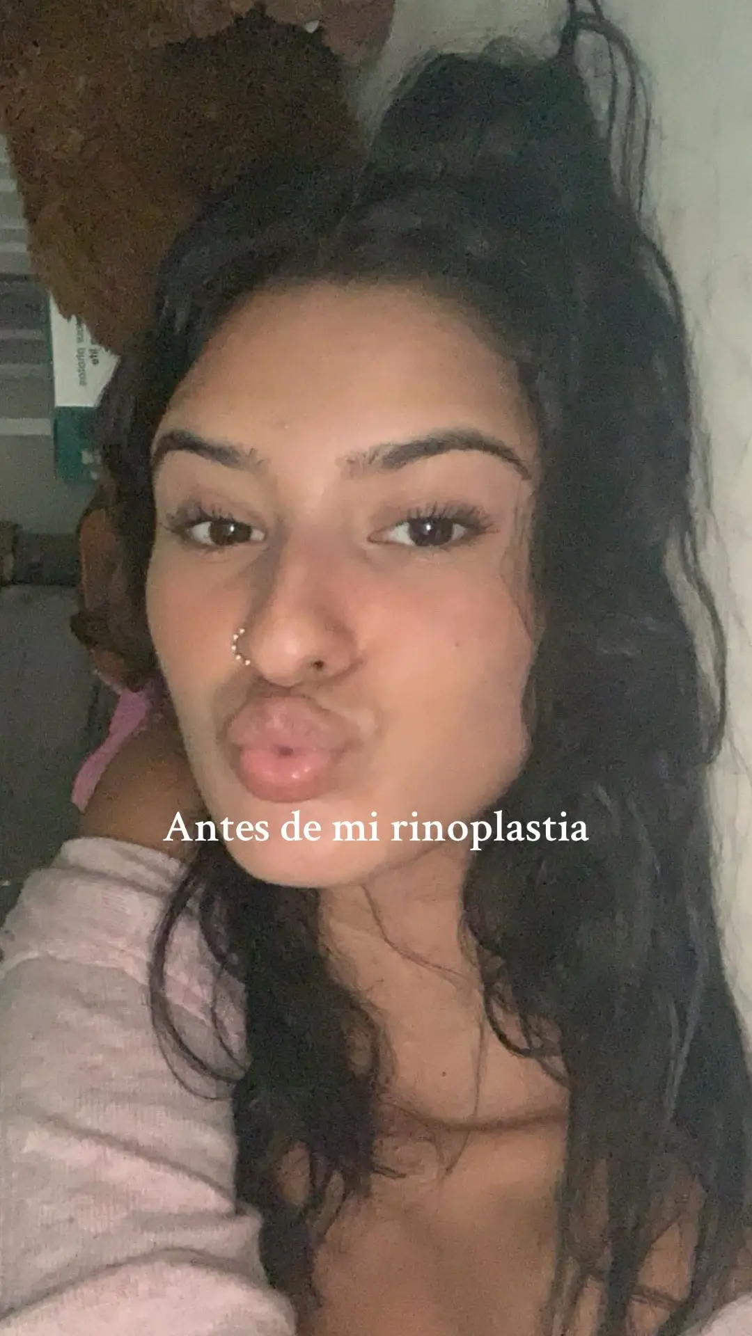 Obsesiónada🤍 #rinoplastia #cirujiasplasticas 
