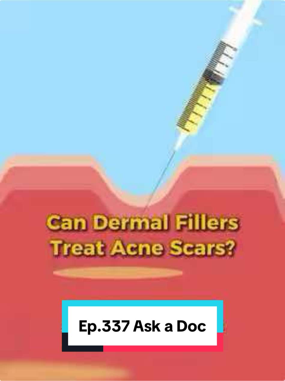 Can Dermal Fillers Help with Acne Scars? 🤔 Yes—dermal fillers can be an effective treatment for certain types of acne scars, particularly atrophic scars such as rolling or boxcar scars that create depressions in the skin. These fillers work by adding volume beneath the indented areas, lifting the scar tissue closer to the level of the surrounding skin. This results in a smoother, more even skin texture. While dermal fillers are widely known for facial contouring and anti-aging purposes, their ability to restore lost volume also makes them suitable for treating specific acne scars. However, they are not a one-size-fits-all solution. Success depends on proper scar assessment, filler selection, and precise technique. 🎥 In this video, Dr. Lennard explains the role of dermal fillers in acne scar management—how they work, who is a suitable candidate, and how they compare to other scar treatment options. #tiktoksg #sgtiktok #skincaretiktok #doctorsoftiktok #medicaltiktok #skintok #dermalfiller #filler #acnescars #acnesolution #acnesarstreatment #glow #collagen #skinrejuvenation #smoothskin #skincare  #inflammation #skinhealth #skintransformation #acnescarsolutions  #lasertreatment #microneedling #acnemarks #skinrepair #ensoul #ensoulmedicalclinic #ensoulmedical #ensoulclinic #medical #aesthetic #laser #laserclinic #sgclinic #skinhealth #sgfyp #fypsg #singapore #sg #aestheticclinic #aestheticclinicsingapore #skintips #drlc #drlennard #drlennardchan #aestheticdoctor #rollingscar #pimplescar #icepickscar #boxcarscar #acnescartreatment #pittedscar Tel: +65 6836 2833 Whatsapp: +65 8798 2892 Email: info@ensoulclinic.com For more information, visit www.ensoulclinic.com
