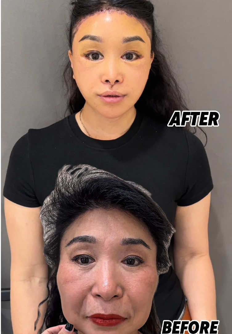 #facelift #facelifting #lowerfacelift #facelifts #aging #agingwell #عمليت #antiaging #عملية #عيادة #عي #جمال #over50 #over60 #lookyoung #foryo #faceliftbeforeandafter #plasticsurgery #deepplanefacelift 