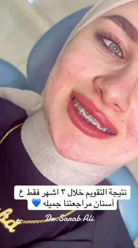 ##تقويم_اسنان #تقويم_الاسنان🦷 #تقويم_شفاف #تقويم_الأسنان #تقويم_معدني #العراق🇮🇶 #مشاهير_تيك_توك_مشاهير_العرب #قشور_خزفية_هوليوود_سمايل_تجميل_اسنان🦷 #