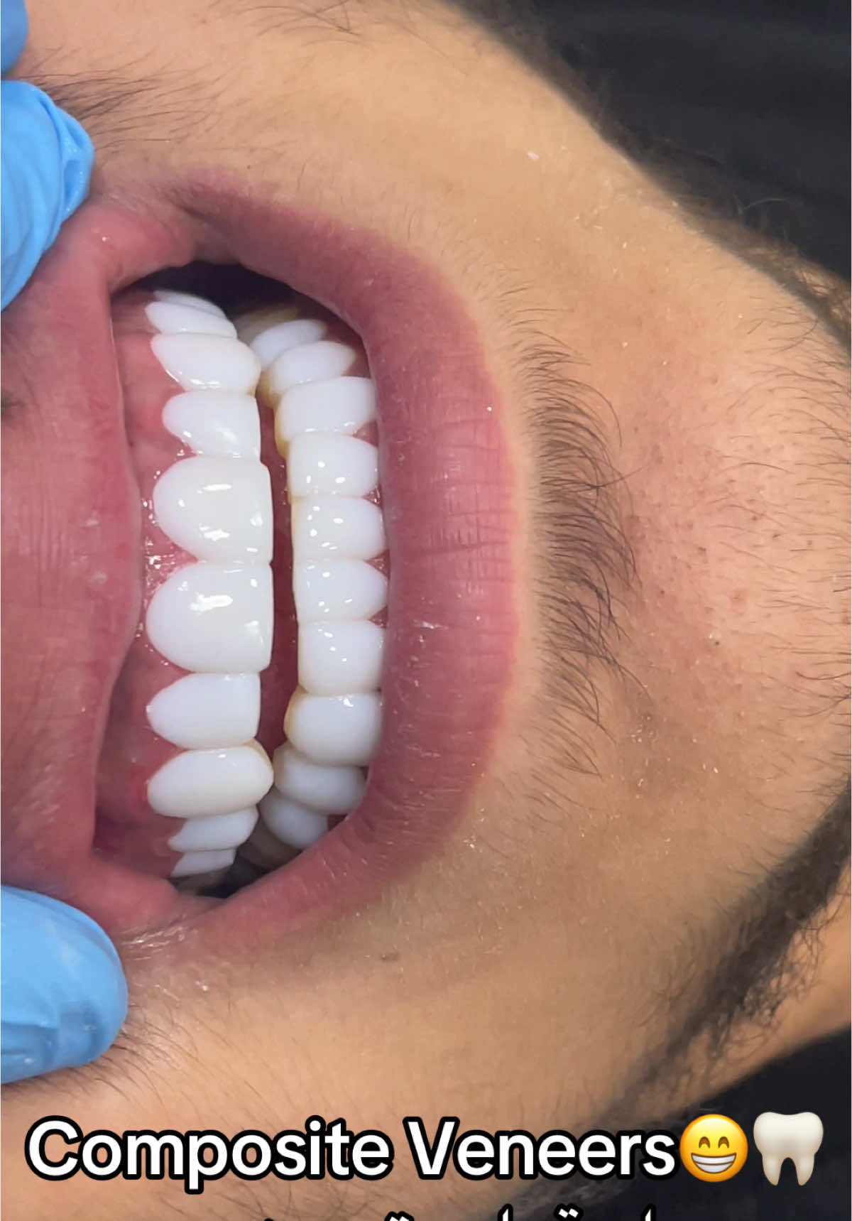 Composite Veneers🦷😁🔥! Book up your appointment at 03095405! #compositeveneers #foryou #foryoupage #foryourpage  #tiktok #trending #fyp  #fypage #fypシ゚viral #lebanon #beirut #explore #fy #fypp #trend   #الشعب_الصيني_ماله_حل😂#اكسبلورexplore#ترند #مشاهير_تيك_توك   #نمبر_ون  #الرقم_الصعب🔥👑  #lebanon🇱🇧  #Love  #art  #artist  #اكسبلور  #foryou  #fypシ゚ #capcut #السعودية🇸🇦 #المغرب🇲🇦تونس🇹🇳الجزائر🇩🇿 #لبنان #بيروت #بيروت_لبنان🇱🇧 #بيروت_لبنان #foryou #مشاهير_تيك_توك #مشاهير #مشاهير_تيك_توك_مشاهير_العرب #مشاهدات #drhmede #capcut  