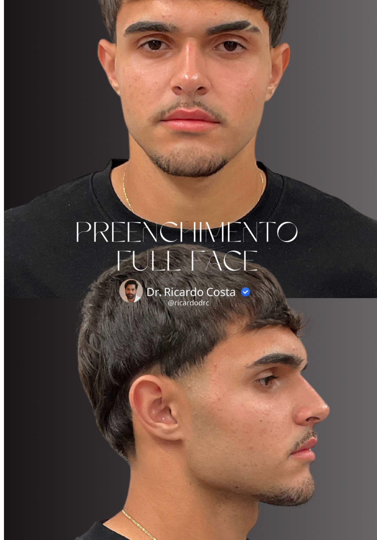 RESULTADO INCRÍVEL! Você acredita no poder dos detalhes? Este paciente me procurou com o desejo de um rosto mais definido. Elaborei um plano de tratamento personalizado, realçando sua beleza de forma sutil. O antes e depois fala por si: pequenas mudanças, grande impacto! Ajudo você a conquistar sua melhor versão! ➡️ Clique no link na bio e agende sua consulta agora mesmo!  - Dr. Ricardo Costa  Medicina Estética  CRM-SP: 242309 #HarmonizaçãoFacial #PreenchimentoFullface  