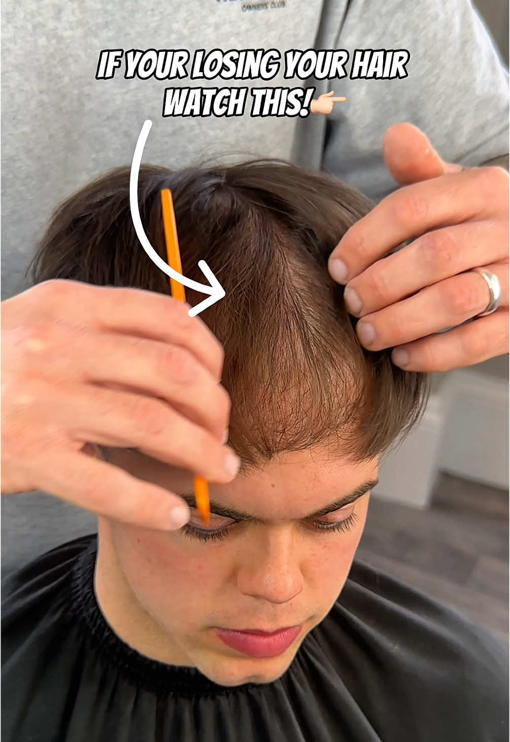 #HairReplacement #hairlosssolutions #receedinghairline #toupeeviral #thinhairhacks #ConfidenceBoost #hairtransplant 