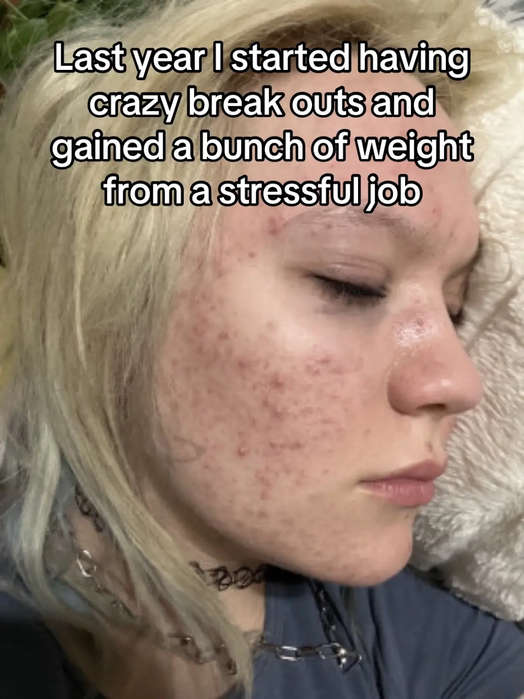 #acne #weightloss #weightlossjouney #skincare #quitmyjob #smallbusinessowner #pressonnails #g59nails #fyp 