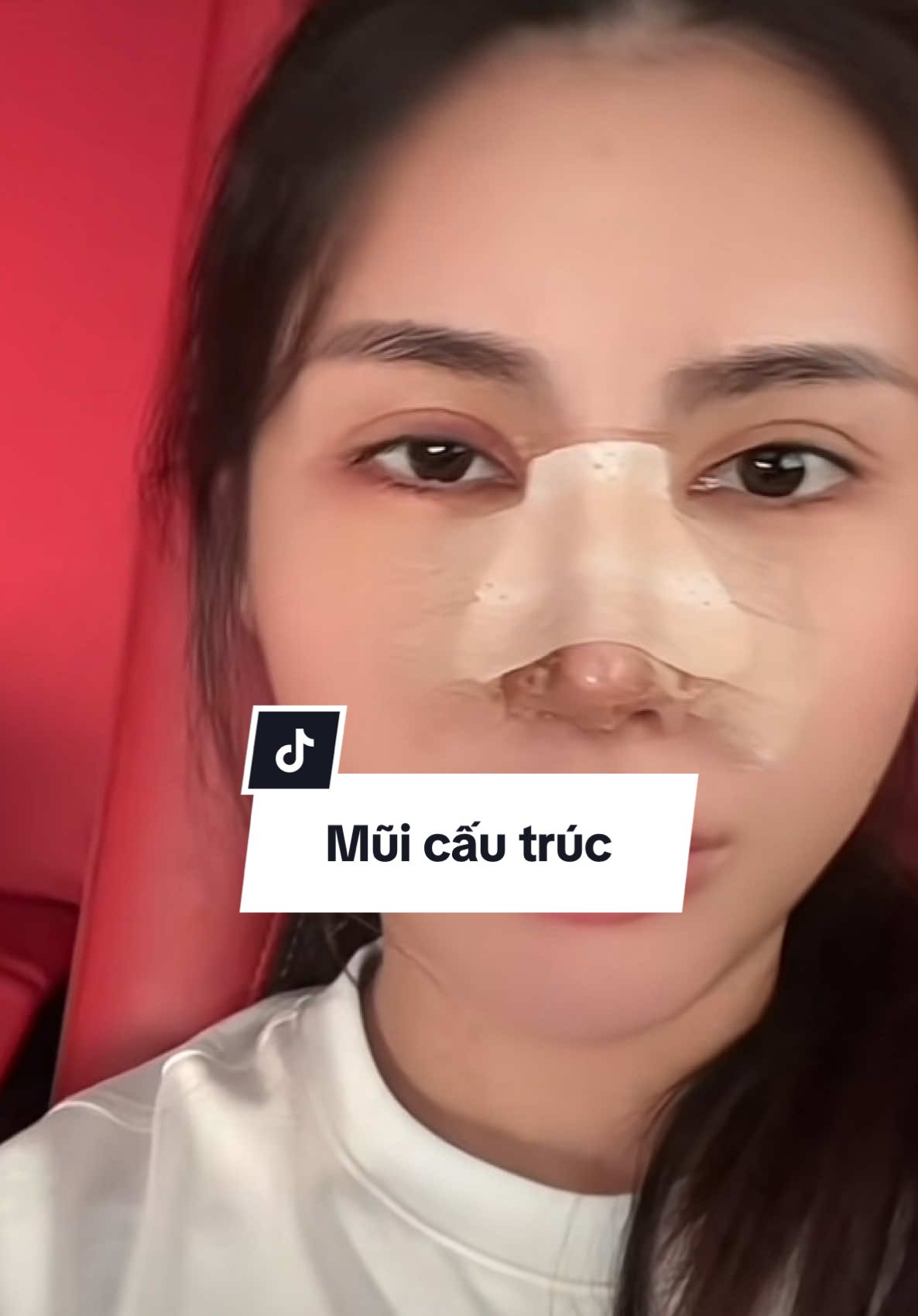 #xuhuongtiktok #suamuihong #PTTM #nguyenvanhieu 