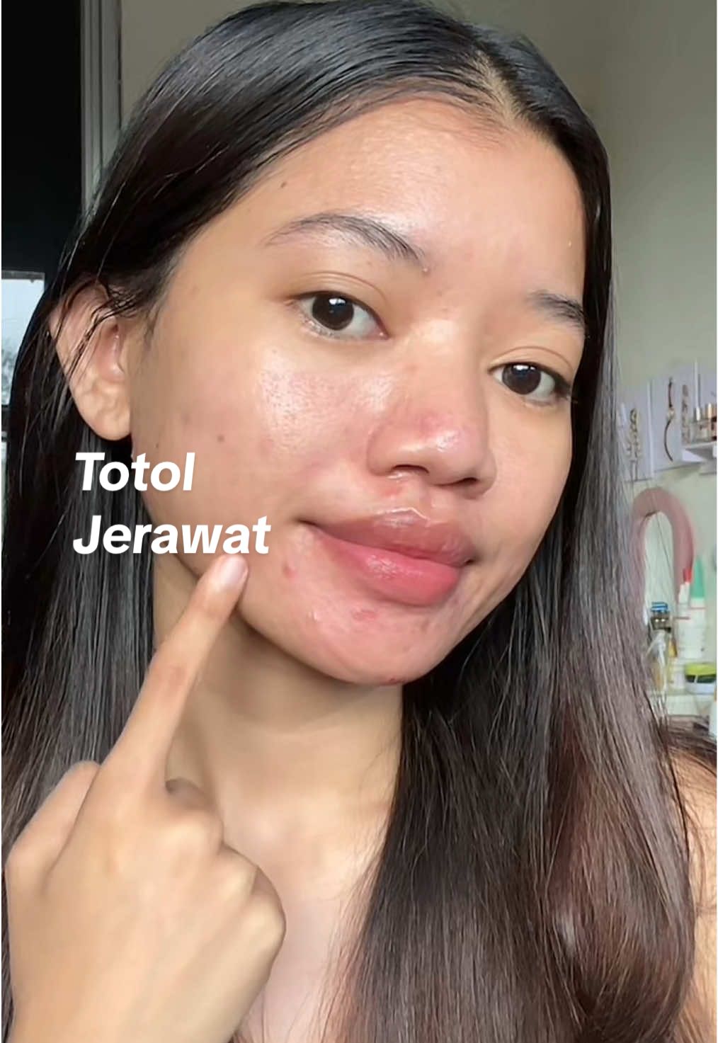 jerawat mendem, jerawat batu atau bruntusan semuanya aku totolin pake ini dan masih jadi top one obat totol jerawat dari semua yang pernah aku cobain sebagai pejuang jerawat 7 tahun 😭💯🙏🏻‼️ #jerawat #kulitberjerawat #jerawatbatu #jerawatmendem #jerawathormon #totoljerawat #rekomendasi #skingame 