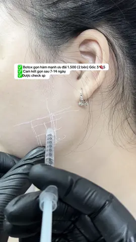 Botox gọn hàm mạnh : Bao gọn_hiệu quả #Macademy #botox_gọn_hàm #trị_hôi_nách #filler_botox_uy_tín 