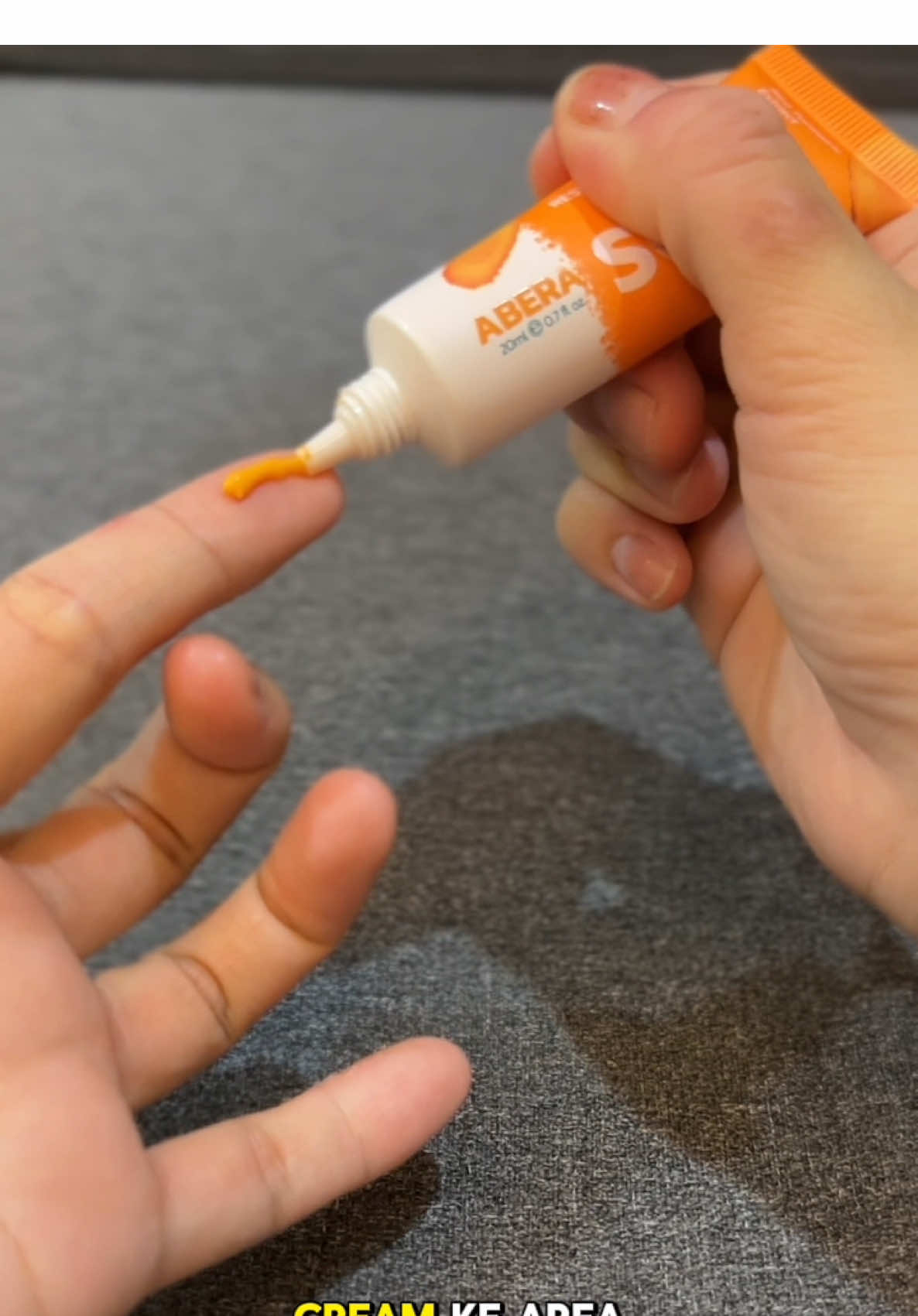 Untuk perawatan bekas luka aku menggunakan Abera Scar Cream dari @Abera Indonesia , yuk buat yang mau cobain lgsg aja checkout keranjang kuning ya✨ #lawankeloidscarwithabera #scarcream 