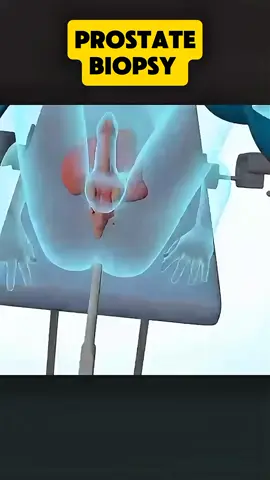 |Prostate biopsy|#ProstateBiopsy  #ProstateHealth  #MensHealth  #Urology  #BiopsyProcedure  #HealthAwareness  #ProstateCare  #MensHealthMatters  #ProstateCheck  #HealthJourney  #PatientSupport 