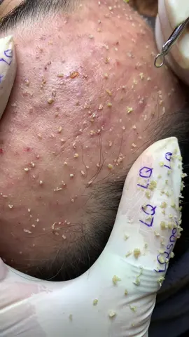 Nằm yên#chamsocdamun#chamsocdaseo#chamsocdanam#tanbinh#govap #Lequynh #quynhle#lqspa #hocnghespa  #chamsocda #lequynhspa #vienthammylqspa#lqspabeautyacdemy #nanmunbangtay #nanmunbangtambong # nanmunbangcay