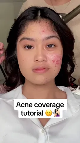 Kl kulit lo berjerawat dan lo mau tutupin kemerahannya tanpa bikin makeup lo keliatan terlalu dempul, video ini utk lo #minimalmakeup #acnecoverage