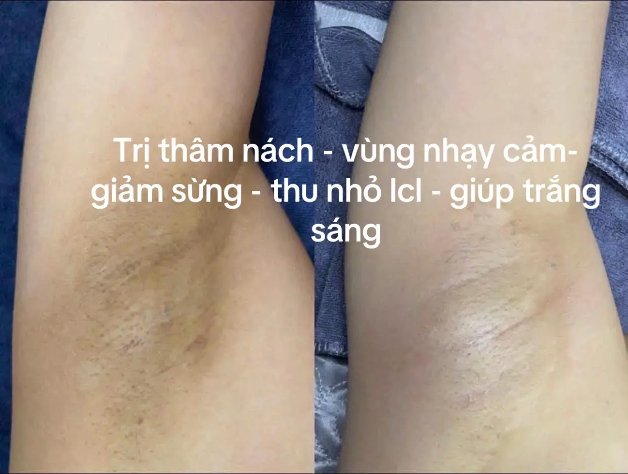 #peel #nach #tritham #thuykieubaeuty #spalamdepbacninh #lamdep #xunhuong 