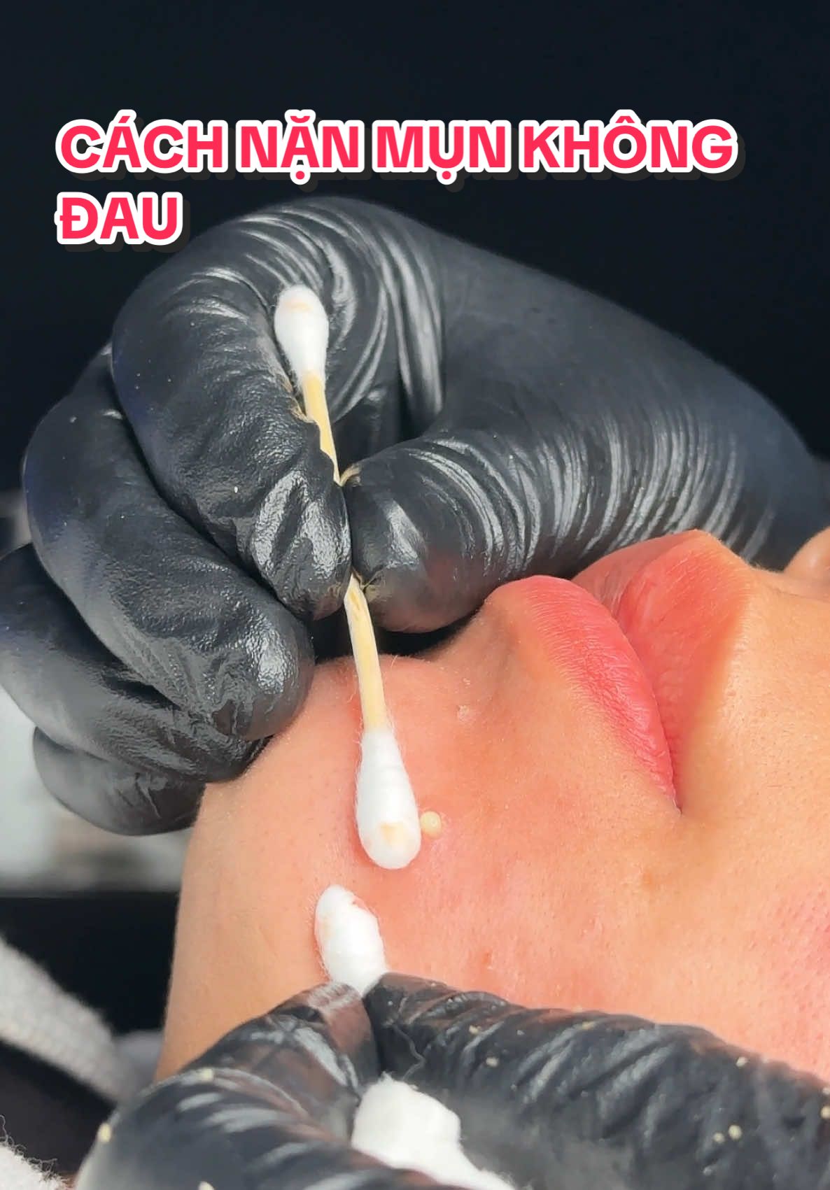 Khách hàng sợ nặn “ Mụn “ vì quá đau, quá ám ảnh, nghĩ đến là thấy nhăn mặt.  ✅ Nhưng tại TSS GLOW-LAB, ca khách này nặn mụn êm đến mức ngủ say lúc nào không biết.  👉🏻Thế mới thấy, nặn mụn không đau phải có kỹ thuật và cách làm chuyên môn cực kỳ cao.  📌Còn ai muốn trải nghiệm hãy ghé chúng mình ngay nhé #viral #thugianmoingay #fyp #nthu_beauté #tss #spaacademy #lamdep #nanmunkhongdau #hetmun 