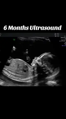 My mini me Stay til the last slide for the Gender 🫣🫣🫣🫣🫣#6monthspregnant#minime#ultrasound#exploretheworld🌎