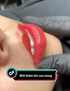Môi sau bong trên nền môi thâm tím và có nhiều đôi mồi#minhtuacademy #phunxamthammy #xuhuong #royallips #treanding #pmu #phunmoibongdam #lamdep 