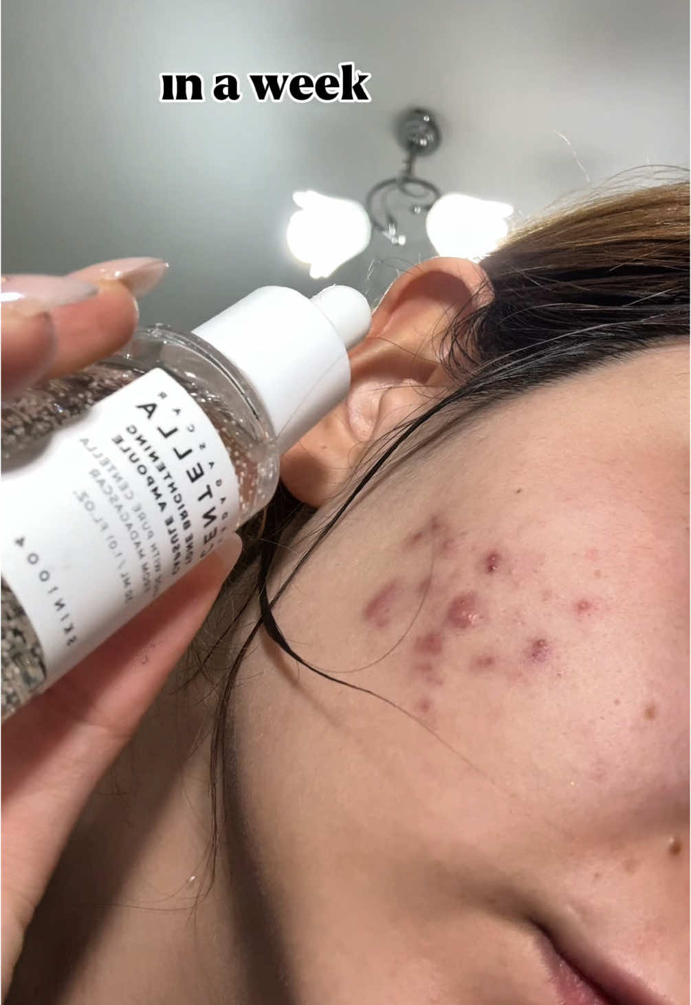 *reklam değil’ || SKIN1004 tone brightening ampoule ❄️ *ürün lekeleri giderme ve açma konusunda başarılı bir ürün olarak çok fazla öneriliyor kesinlikle sivilcelerde bir etkisi olmamaktadır’  (ürünü sivilcelerim geçsin diye değil lekelerimin rengi açılsın diye kullandım ve sonuç gayette başarılı❤️)  *kendimsatınaldım (işbirliği,reklam yoktur)  • #darkspots  #hyperpigmentaiton #skincareroutine #koreanskincare #centella #skin1004 #tiktokmademebuyit #gratis 