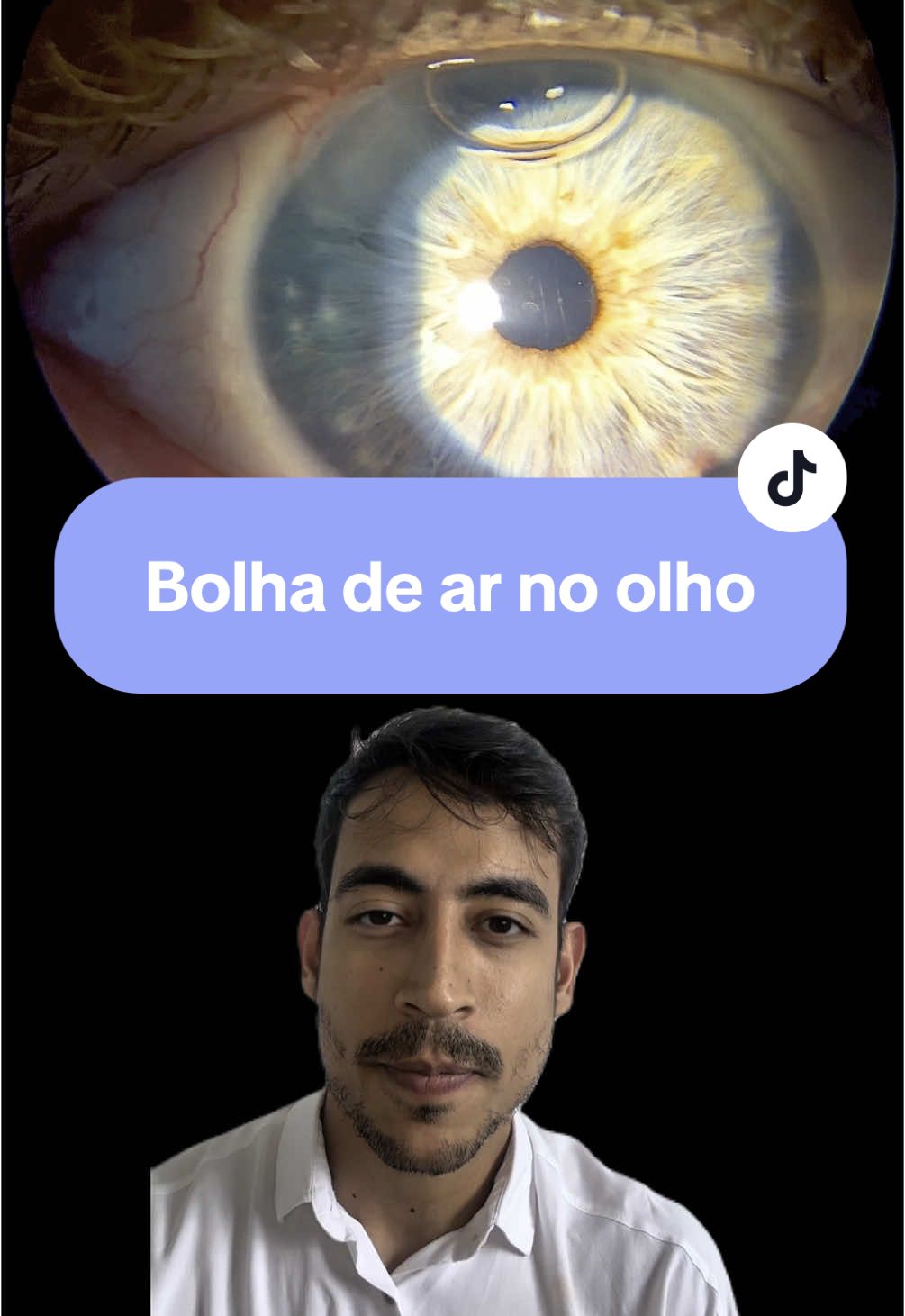 Você já viu uma bolha de ar no olho? 🫧 Acontece… #catarata #oftalmologia #refrativa #fy #visao 