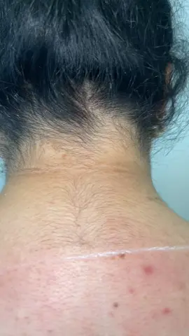 تحديد منطقه الرقبه بجهاز الكانديلا الثلجي #ليزر #ازالة_الشعر #ليزر_ازالة_شعر #كانديلا_جنتل_ليز_الأمريكي #ليزر_جسم #ليزر_الشعر #كانديلا_جنتل_ماكس_برو #فديوهات 