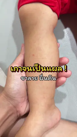 ผื่นคัน ผื่นยุงกัด ใช้คาราไมน์เด็กเลยแม่ 💖✨ #คาราไมน์มาสเตอร์แรบบิท #คาราไมน์เด็ก #ผื่นคัน #ผื่นเด็ก #ของดีแม่และเด็ก 