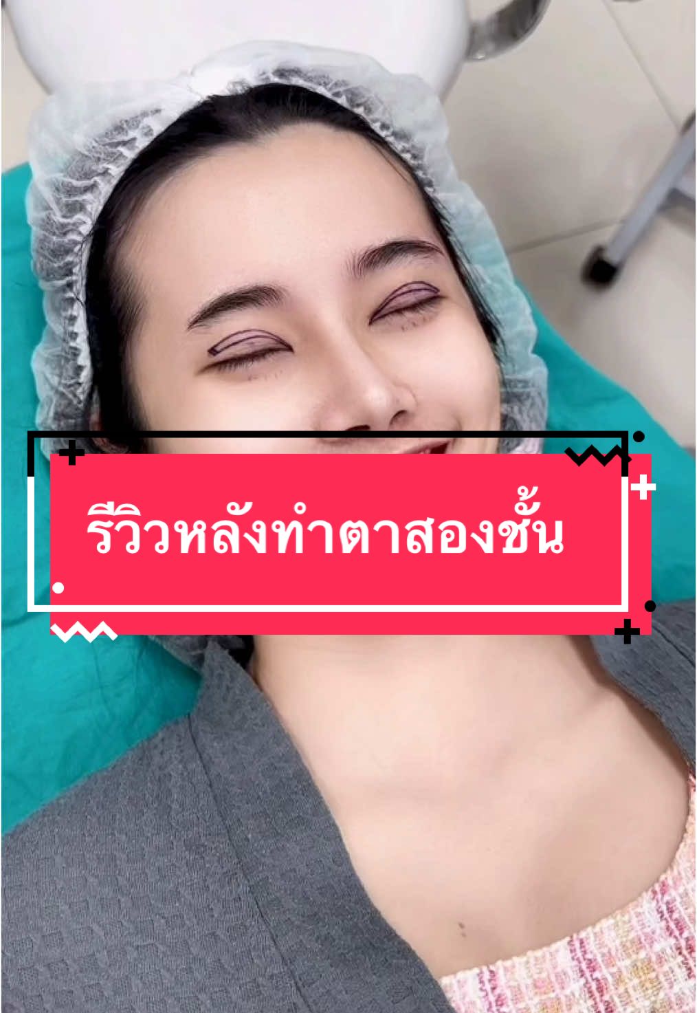 ตื่นมารอบนี้มีตาสองชั้นแล้วววว #dscclinic #ศัลยกรรม #หมอมาร์ค #ทําตาสองชั้น @เสริมจมูก by DSC Clinic 