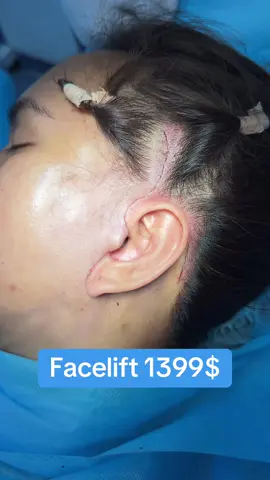 #surgery #operation #lamdep #facelift #cangda #cangdagiauchi #cangdamini 