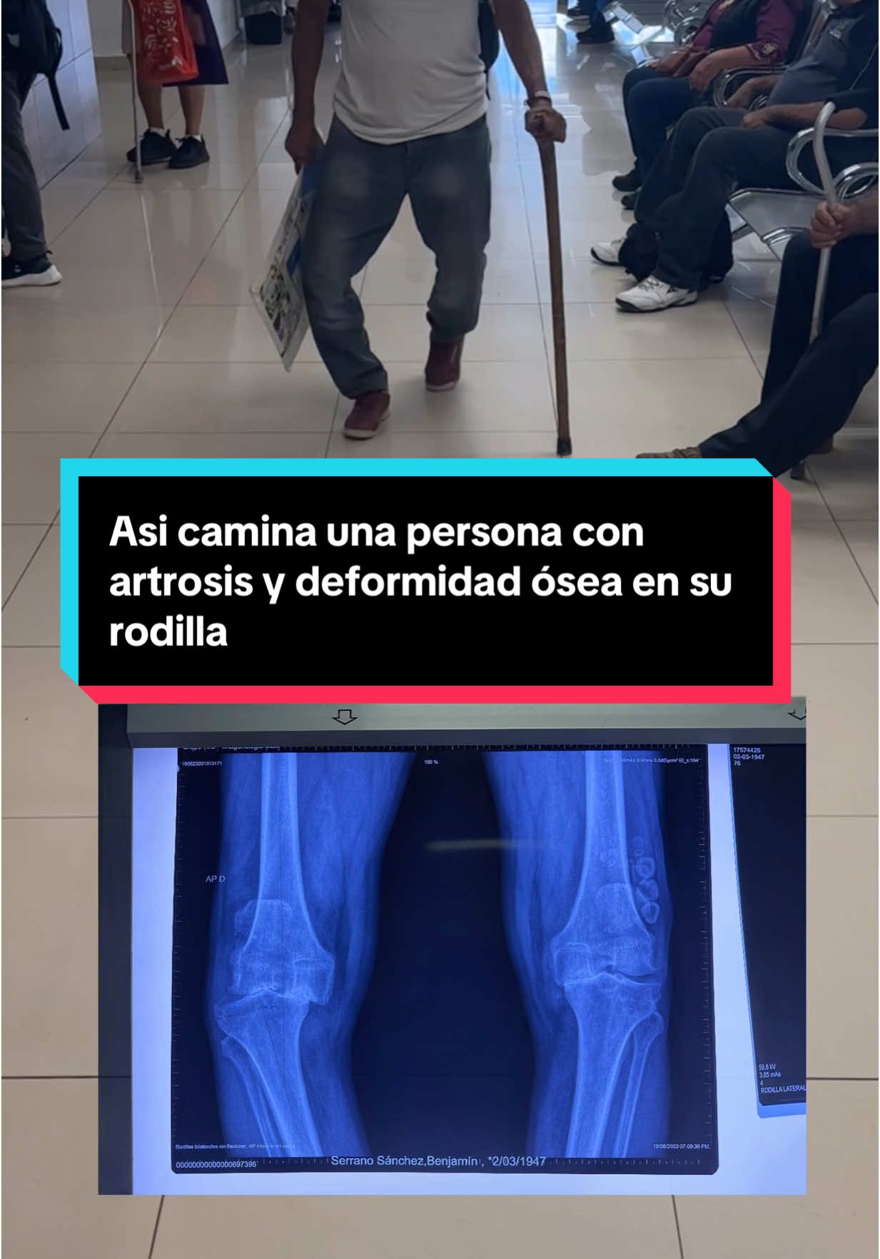 Existe un antes y un despues de una persona que no se opera de una prótesis total de rodilla, su cambio es sorprendente!  #DolorDeRodilla #deformidadenrodillas #protesisrodilla #TaumatologoGabriel #rodillamala #desgasterodilla #protesisrodilla 
