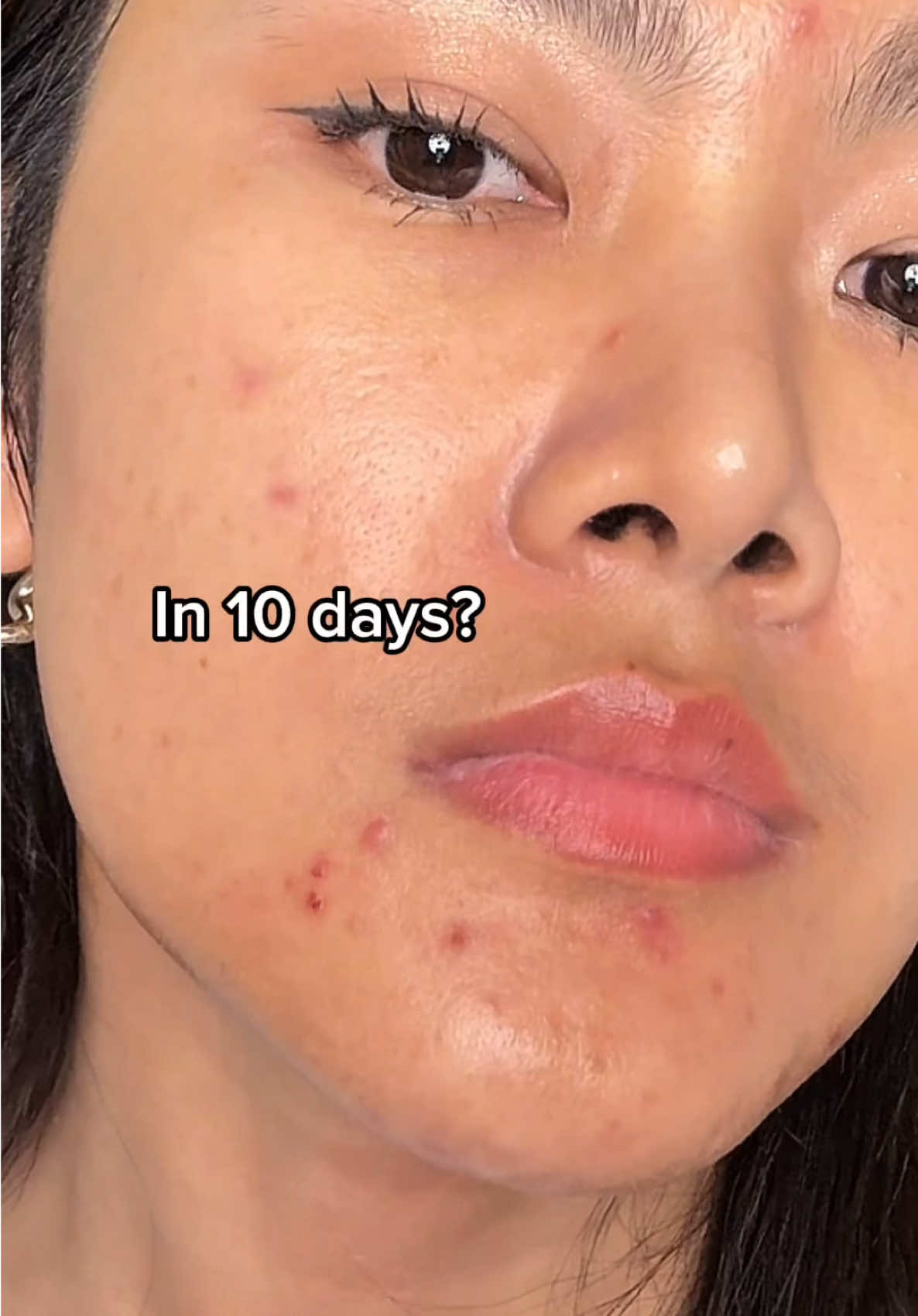 สิวหายใน 10 วัน? #tiktokบิวตี้ #รีวิวบิวตี้ #ของดีบอกต่อ #รักษาสิว #anua #anuaazelaicacidserum #azelaicacid #acneproneskin #acneskin #skintok #skincare 