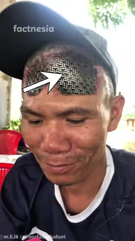 tambal ban❌ tambal kepala✅. Plat titanium ini biasa digunakan sebagai pengganti tengkorak yang rusak. #factnesia #education #information #fyp 