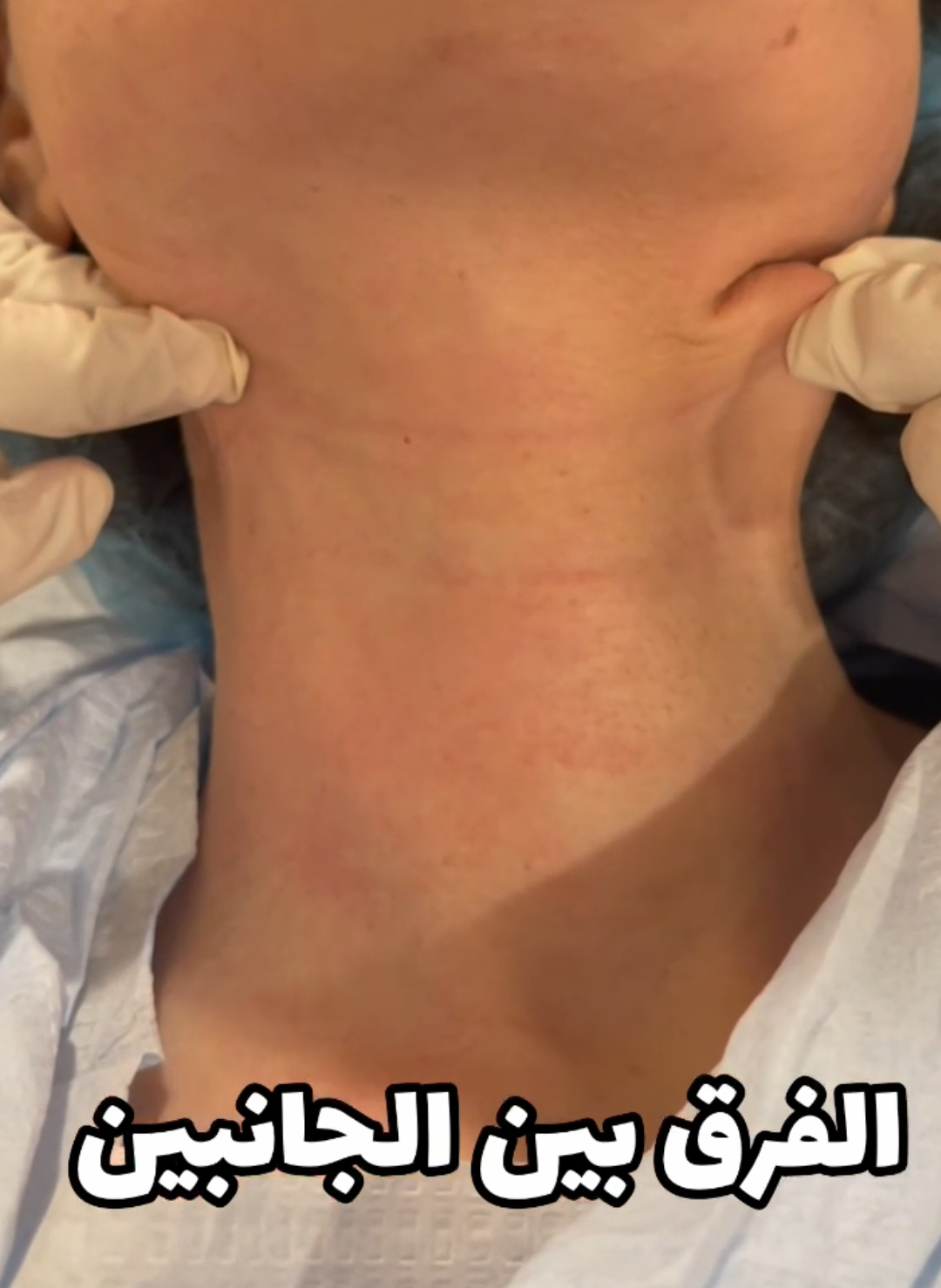 الرقبة من أهم المناطق التي تبين عُمر المرأة والاعتناء بها يعطي مظهرا أكثر شبابا ‎و قد لاتحتاج معظم الحالات الى تدخل للشد الجراحي ‎فيمكن عن طريق الليزر الداخلي يشد التجاعيد بدون إبر  ‎ويجدد البشرة عن طريق تحفيز الكولاجين واعادة بناء طبقات الجلد  ‎او عن طريق حقن الكالسيوم او البوتكس  ‎حسب الحاله يتم تحديد الاجراء المناسب. ____________________ Beauty can be achieved by art in a natural way 🌹 @dr_shahenda_radwan @dr_shahenda_radwan ‎للحجز أو الاستفسار يرجى الاتصال على 👇🏻👇🏻👇🏻 📱+965 50526255 📱+965 94467684 ‎ونسعد بزيارتكم دائما بعيادتنا 😍 ‎السالمية قطعة ٣ _ شارع سعيد بن المسيب ‎مركز بوفارديا الطبي الدور الثامن .. الدكتورة شاهندة رضوان ____________________ #الدكتورة_شاهندة_رضوان#نضارة #ليزر #شيخوخة #جلدية #جلدية #الدكتورة_شاهندة_رضوان ##شد 