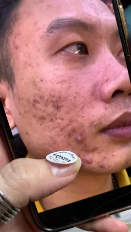 Da Mụn #chamsocdamun#chamsocdaseo#chamsocdanam#tanbinh#govap #Lequynh #quynhle#lqspa #hocnghespa  #chamsocda #lequynhspa #vienthammylqspa#lqspabeautyacdemy #nanmunbangtay #nanmunbangtambong # nanmunbangcay