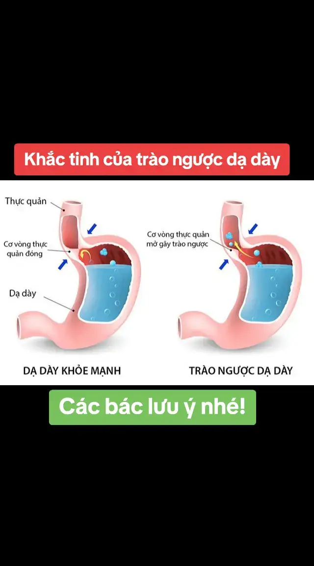 1. Trào ngược dạ dày thực quản có tên khoa học là Gastroesophageal Reflux Disease (GERD) là tình trạng axit dạ dày trào ngược lên thực quản. Trong điều kiện sinh lý bình thường, mỗi khi chúng ta ăn uống, thức ăn đưa từ miệng xuống thực quản, cơ thắt thực quản dưới sẽ giãn ra để thức ăn, các dịch lỏng di chuyển vào dạ dày. Sau đó cơ thắt này sẽ đóng lại. Bệnh trào ngược dạ dày thực quản xảy ra khi dịch dạ dày trào ngược lên gây tổn thương các cơ quan thực quản. 2. Dấu hiệu nhận biết bệnh trào ngược dạ dày Khi mắc bệnh trào ngược dạ dày thực quản, bệnh nhân sẽ có những biểu hiện dấu trào ngược dạ dày trong thực quản và ngoài thực quản như sau: 2.1. Biểu hiện trong thực quản •  Ợ hơi, ợ nóng, ợ chua Ợ hơi là hiện tượng có quá nhiều không khí thừa trong dạ dày và sau đó quay ngược trở lại thực quản. Nếu xảy ra thường xuyên thì đây là một trong những dấu hiệu bệnh trào ngược dạ dày thực quản. Ợ nóng là cảm giác nóng rát vụng thượng vị, dưới xương ức lan lên cổ. Ợ chua thường đi kèm với ợ hơi và ợ nóng, để lại vị chua trong miệng. Các triệu chứng trên thường xuất hiện khi ăn no, khi đầy bụng hoặc lúc nằm ngủ, đặc biệt xuất hiện nhiều vào ban đêm. •  Buồn nôn, nôn Sự trào ngược của axit vào họng hoặc miệng, kích thích họng miệng gây cảm giác buồn nôn nặng hơn có thể nôn ra dịch vị hoặc thức ăn. •  Đau tức ngực thượng vị Khi bị trào ngược dạ dày thực quản, người bệnh có thể có cảm giác bị đau thắt ở ngực xuyên ra sau lưng tuy nhiên không phải do bệnh tim gây ra. Nguyên nhân do axit trào ngược lên kích thích vào các đầu mút sợi thần kinh trên bề mặt niêm mạc thực quản, cơ quan cảm ứng đau sẽ đưa ra tín hiệu như đau ngực. Nếu đau thắt vùng ngực khó thở này xảy ra với cường độ mạnh khi cúi gập người, nằm xuống cùng 1 số triệu chứng đi kèm liệt kê ở bài viết này thì bạn mắc phải bệnh lý trào ngược dạ dày thực quản chứ không phải bệnh tim. •  Khó nuốt Trào ngược dạ dày thực quản với tần suất lớn gây viêm, sưng tấy, làm thu hẹp đường kính thực quản. Vì thế người bệnh có cảm giác khó nuốt, nuốt vướng ở cổ. •  Khản giọng và ho Do dây thanh quản bị tổn thương khi tiếp xúc với axit dạ dày. Người bệnh trào ngược dạ dày sẽ bị khản giọng do dây thanh phù nề, khó nói và lâu ngày thành ho do dịch viêm chảy xuống thanh phế quản. Bên cạnh đó trào ngược dạ dày gây khó thở cũng là dấu hiệu phổ biến. 2.2. Biểu hiện ngoài thực quản Bệnh cạnh những dấu hiệu xảy ra bên trong thực quản thì người mắc bệnh trào ngược dạ dày thực quản có thể gặp những biểu hiện trào ngược dạ dày khác như: Viêm họng kéo dài, viêm thanh quản, hôi miệng, răng xỉn màu... •  Miệng tiết nhiều nước bọt Khi bị trào ngược dạ dày, để trung hòa lượng axit cơ thể sẽ tự tiết ra nước bọt nhiều hơn. Tuy nhiên điều này có thể làm tăng  lượng không khí đi vào dạ dày gây ợ hơi, ợ nóng. •  Đắng miệng Trào ngược dạ dày làm cho van môn vị bị đóng mở quá mức. Dịch mật theo đó trào ngược từ tá tràng vào trong dạ dày, theo axit tràn lên thực quản và vào tới khoang miệng gây ra cảm giác đắng miệng. Hiện tượng này thường xảy ra vào sáng sớm khi vừa ngủ dậy •  Khó thở và hen suyễn Trào ngược dạ dày thực quản có thể liên quan đến khó thở như co thắt phế quản hoặc nghẹt thở. Nguyên nhân do axit chảy ngược vào thực quản có thể xâm nhập vào phổi đặc biệt là trong khi ngủ gây sưng đường thở. Điều này có thể dẫn đến hen suyễn hoặc viêm phổi. Tổn thương đường thở như vậy thường biểu hiện là ho hoặc thở khò khè. •  Viêm họng kéo dài, viêm thanh quản Khi axit trào ngược dâng cao lên vòm họng sẽ làm tổn thương niêm mạc họng và dây thanh quản. Nếu bệnh trào ngược kéo dài sẽ gây thành viêm họng mãn tính với những cơn đau buốt vùng họng và khản tiếng •  Răng xỉn màu Men răng có thể bị ảnh hưởng bởi axit trào ngược gây mòn men răng, làm răng trở nên xỉn màu, kèm theo đó hơi thở có mùi hôi. #traonguocdaday #suckhoe #health #aiamhappy #xuhuongtiktok #ilovetiktok 