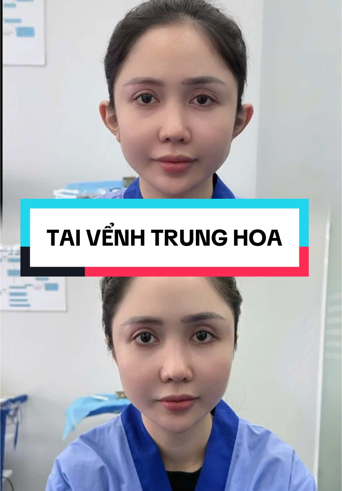 Tai vểnh trung hoa xu hướng hiện nay🥰🥰🥰 #xuhuong #phauthuatthammy #xuhuongtiktok #độntaivểnh #làmđẹp #antoan #xinh 