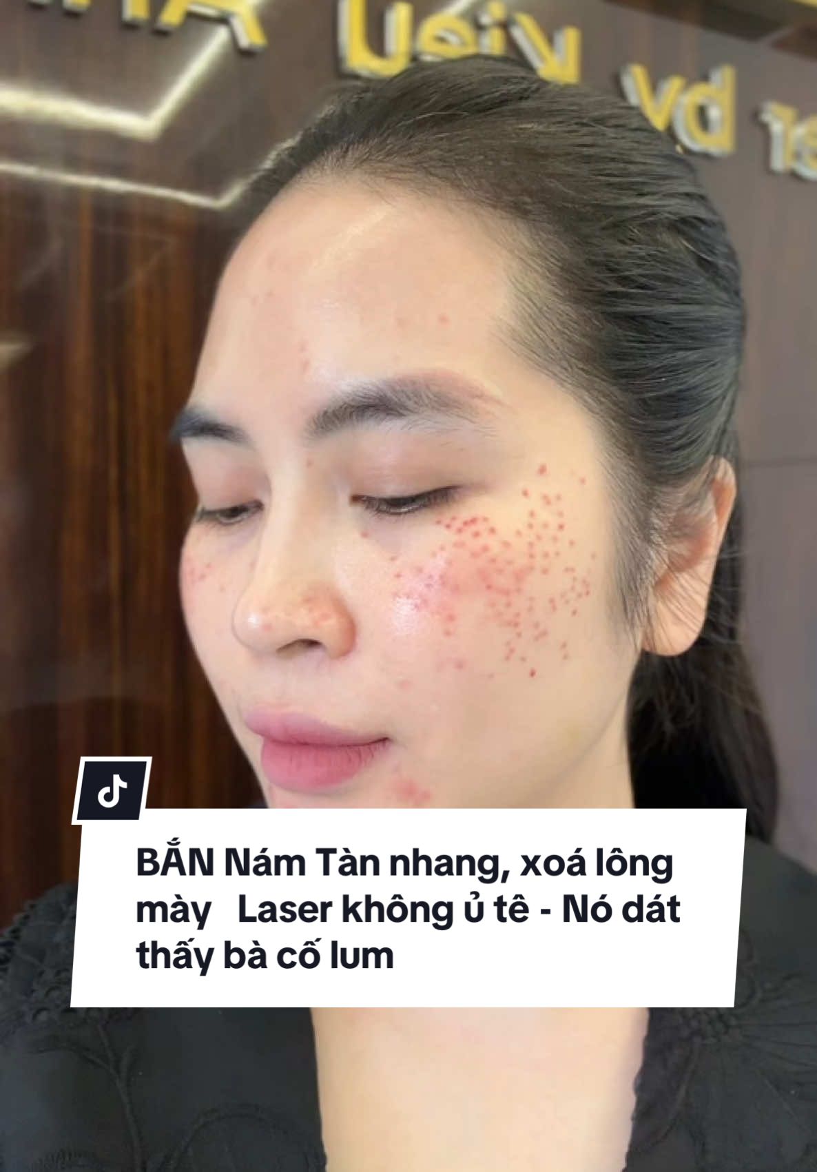 P188 : Rồi đến Câu Chuyện :  Tui Bắn Nám Tàn Nhang sau 10 năm !! Với phương pháp mới Tui trả Da cực nhanh cho khách !! Bao luôn không xấu !!  ✔️ Hôm nay Tui làm không ủ Tê : Tui bắn Tàn Nhang , Nám Tui bắn sống luôn 🙈 nó Dát thấy bà cố nha  ✔️ Tui xoá lông mày sống ko tê nha . Tui trở về mày nguyên bản , tui mới bắn laser song nên nó đang đỏ , nề nhẹ này !  ✔️ Tui Peel Da Tui cũng làm chay luôn  Lòi mắt tìm từng con Tàn nhang tui diệt ko còn tí nào !  Rùi chờ Tui 10 ngày đi !! #kieuanhngo93 #bodytrangda #hocnghespa #vienthammylamerci #Tămtrangbody #luxurybodywhite #luxurybodywhite #tiktok 